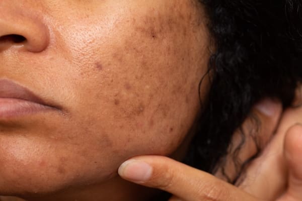 Let's Talk Hyperpigmentation